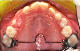 Palatal arch — 외부 임상 사진